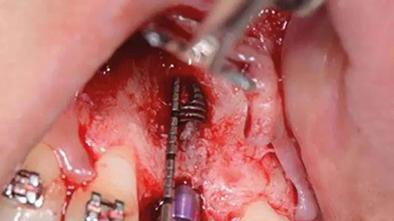 Treatment of an implant dehiscence using cerabone® and permamem®