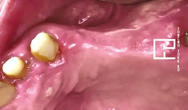 Image for case Implant placement and horizontal GBR using permamem® and cerabone®