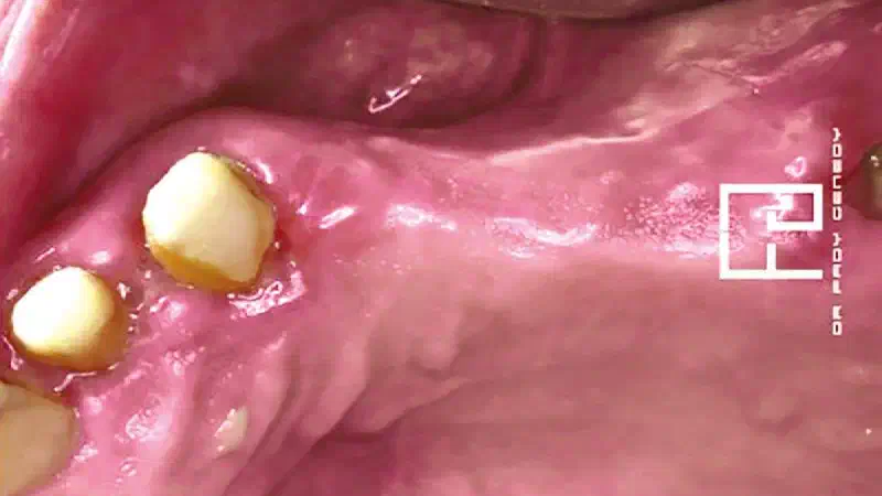 Implant placement and horizontal GBR using permamem® and cerabone®