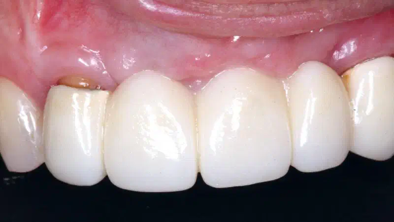 Horizontal GBR using permamem®, cerabone® and maxgraft® granules and soft tissue augmentation with mucoderm®