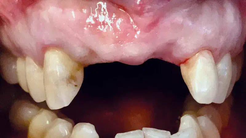 Implant placement and ride augmentation using autologous bone, cerabone® and permamem®