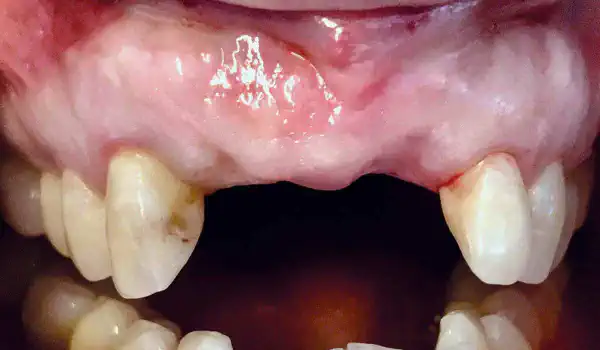 Image for case Implant placement and ride augmentation using autologous bone, cerabone® and permamem®
