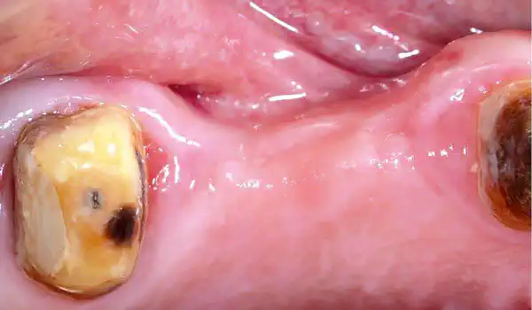 Image for case Lateral ridge augmentation using autologous bone, cerabone® and permamem®