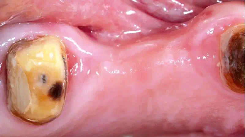 Lateral ridge augmentation using autologous bone, cerabone® and permamem®