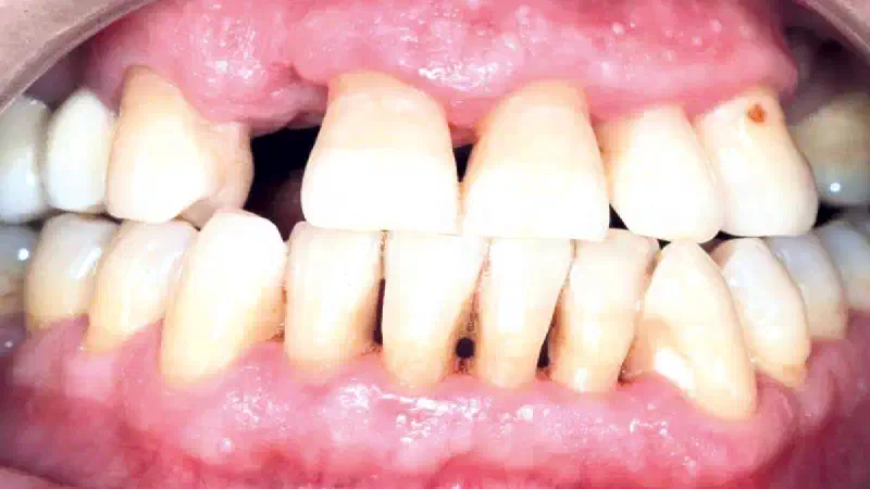 Ridge augmentation using cerabone® and permamem®
