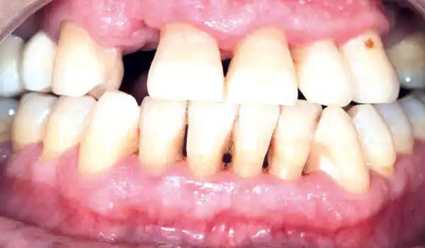 Image for case Ridge augmentation using cerabone® and permamem®