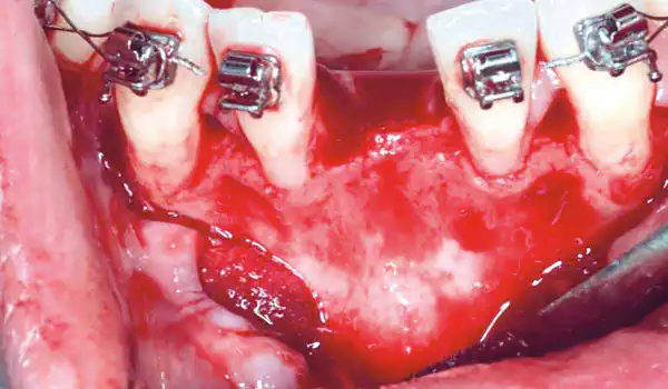 Image for case Horizontal GBR in the anterior mandible
