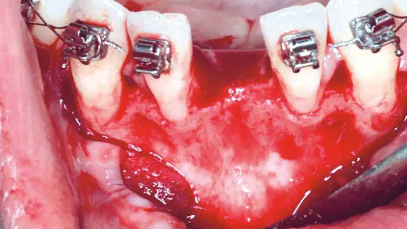 Horizontal GBR in the anterior mandible
