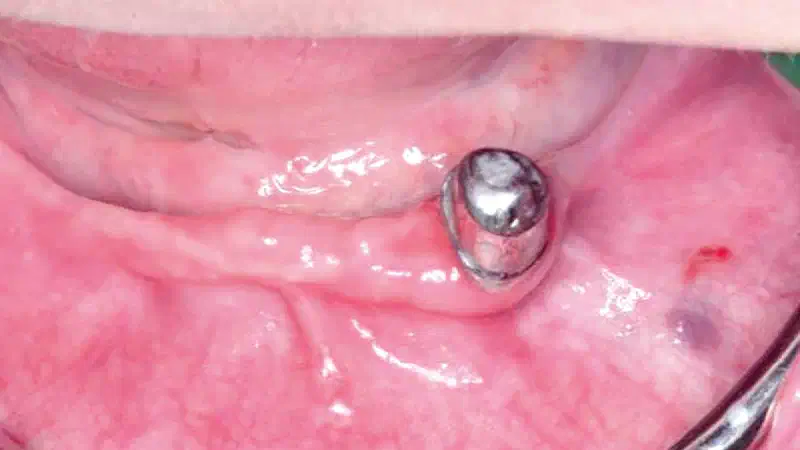 Horizontal ridge augmentation using autologous bone, cerabone® and permamem®
