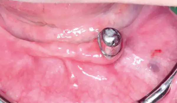 Image for case Horizontal ridge augmentation using autologous bone, cerabone® and permamem®