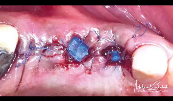 Image for case Socket management in the posterior maxilla using permamem® and cerabone®