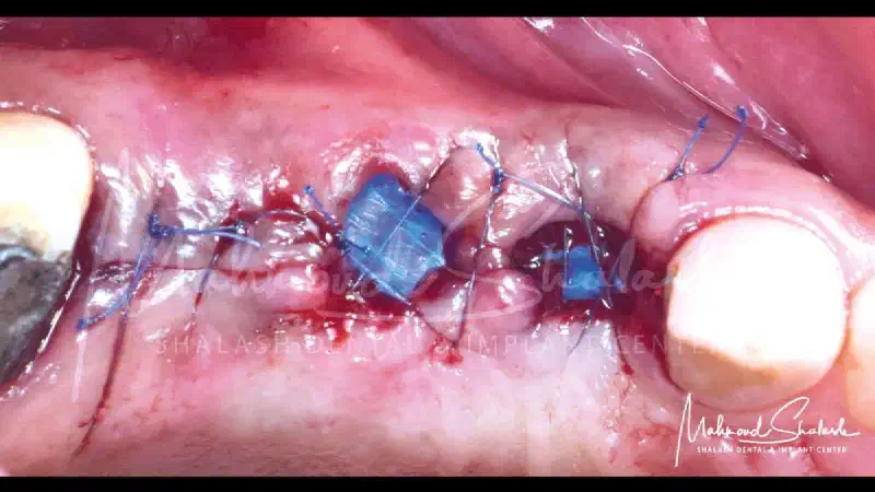 Socket management in the posterior maxilla using permamem® and cerabone®