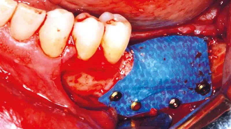 Vertical and horizontal GBR in the posterior mandible using permamem® and cerabone®