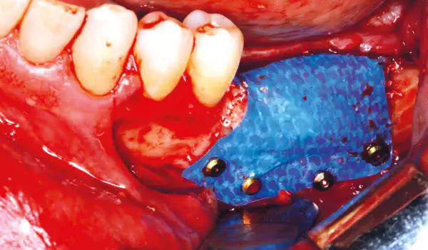 Image for case Vertical and horizontal GBR in the posterior mandible using permamem® and cerabone®
