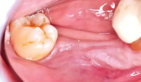 Image for case Vertical and horizontal GBR using permamem®, cerabone® and autologous bone