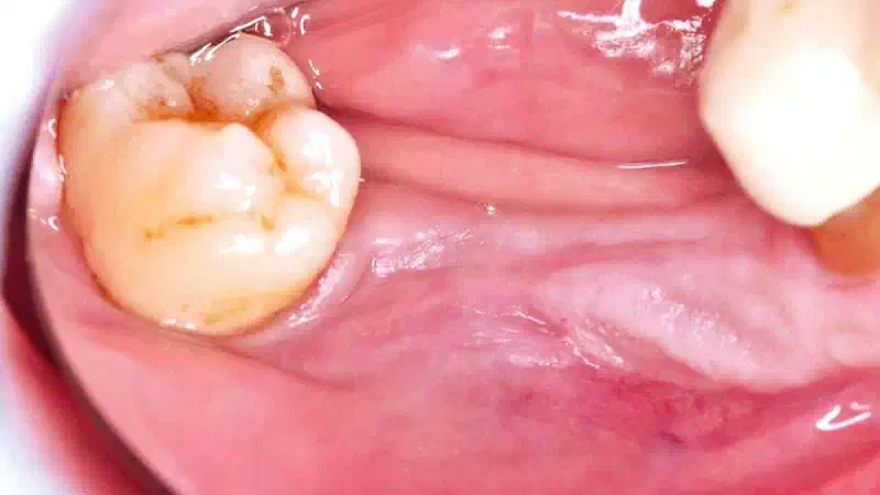 Vertical and horizontal GBR using permamem®, cerabone® and autologous bone