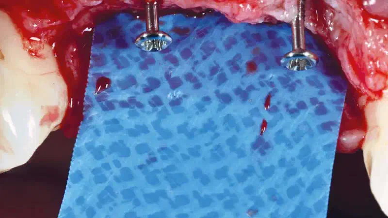 Vertical ridge augmentation with permamem®, cerabone® and autologous bone chips