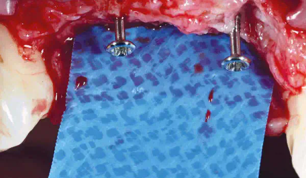 Image for case Vertical ridge augmentation with permamem®, cerabone® and autologous bone chips