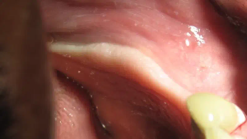 Ridge splitting with cerabone®