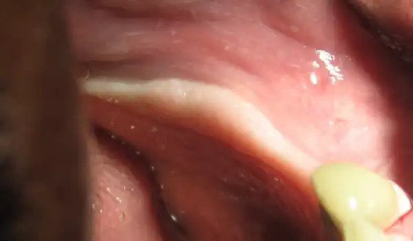 Image for case Ridge splitting with cerabone®