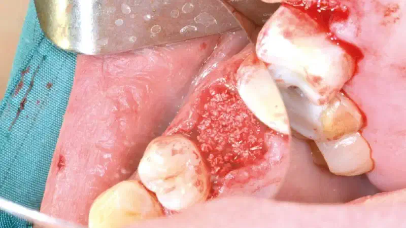 Socket preservation with cerabone®