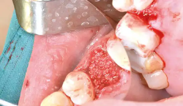 Image for case Socket preservation with cerabone®