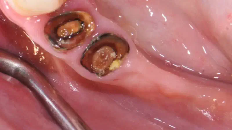 Ridge augmentation with maxgraft® bonebuilder & collprotect® membrane