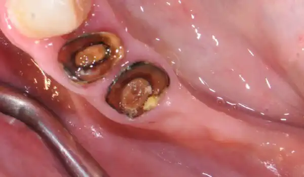 Image for case Ridge augmentation with maxgraft® bonebuilder & collprotect® membrane