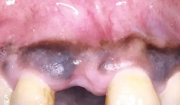 Image for case Treatment of a fenestration defect using maxgraft® and permamem®