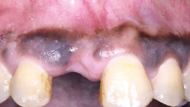 Treatment of a fenestration defect using maxgraft® and permamem®