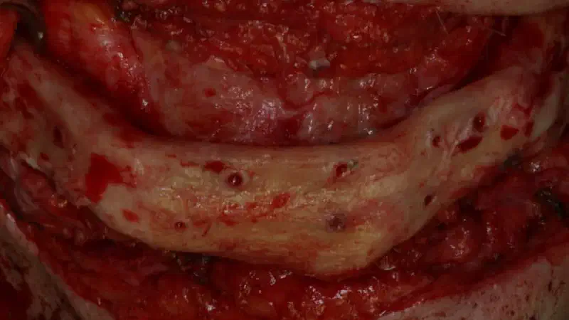 Block augmentation with maxresorb®, collprotect® membrane & autologous bone blocks