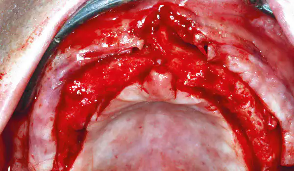 Image for case Ridge augmentation by circular bone splitting and the use of maxresorb® and collprotect® membrane