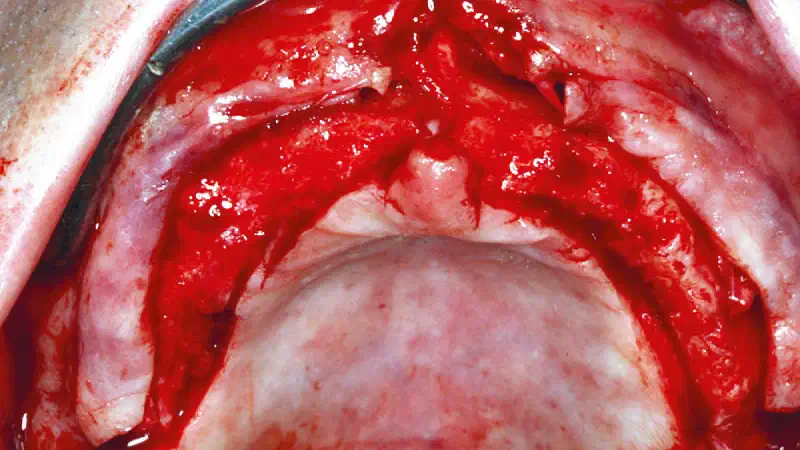 Ridge augmentation by circular bone splitting and the use of maxresorb® and collprotect® membrane