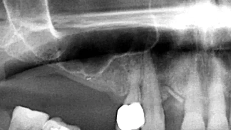 Sinus- and bone defect augmentation using maxresorb® and Jason® membrane