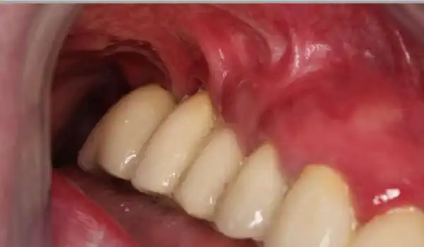 Image for case Augmentation of the keratinized tissue in the posterior maxilla with mucoderm®