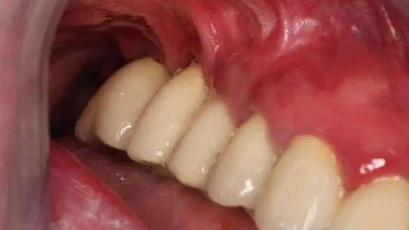 Augmentation of the keratinized tissue in the posterior maxilla with mucoderm®