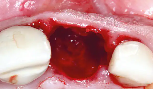 Image for case Socket augmentation using mucoderm®, maxgraft® and Straumann® Emdogain®
