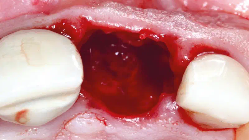 Socket augmentation using mucoderm®, maxgraft® and Straumann® Emdogain®