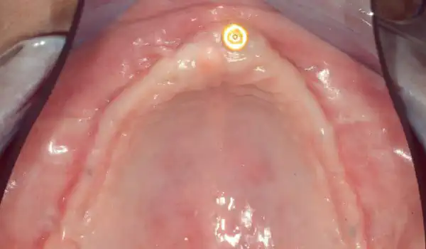 Image for case mucoderm® for full arch reconstruction of insufficient vestibular depth and lack of keratinized tissues