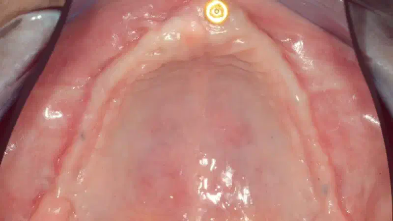 mucoderm® for full arch reconstruction of insufficient vestibular depth and lack of keratinized tissues