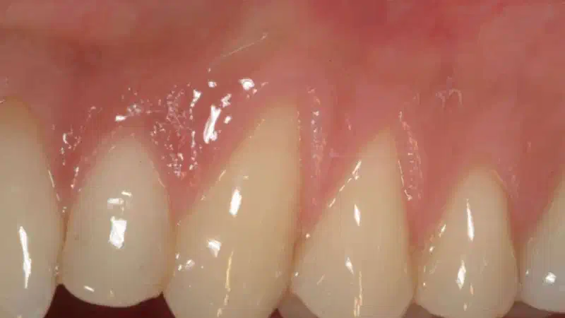 Multiple recession coverage with mucoderm® and Straumann® Emdogain® – 4 year follow-up