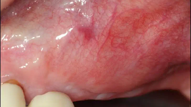 Widening of the peri-implant keratinized mucosa in the upper jaw with mucoderm®