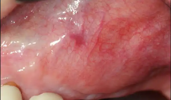 Image for case Widening of the peri-implant keratinized mucosa in the upper jaw with mucoderm®