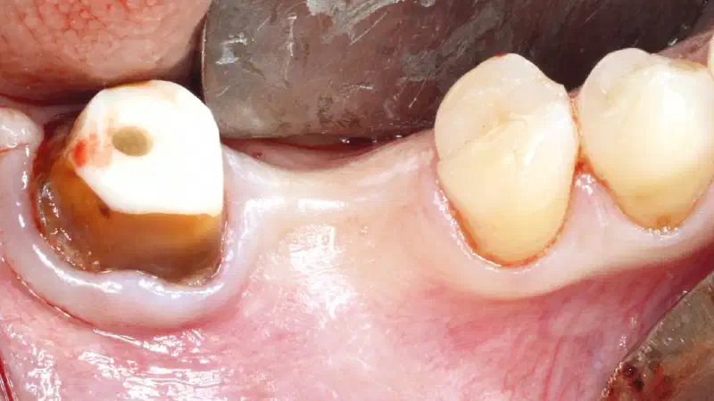 “Poncho technique” with mucoderm® and Straumann® Emdogain® for peri-implant soft tissue augmentation