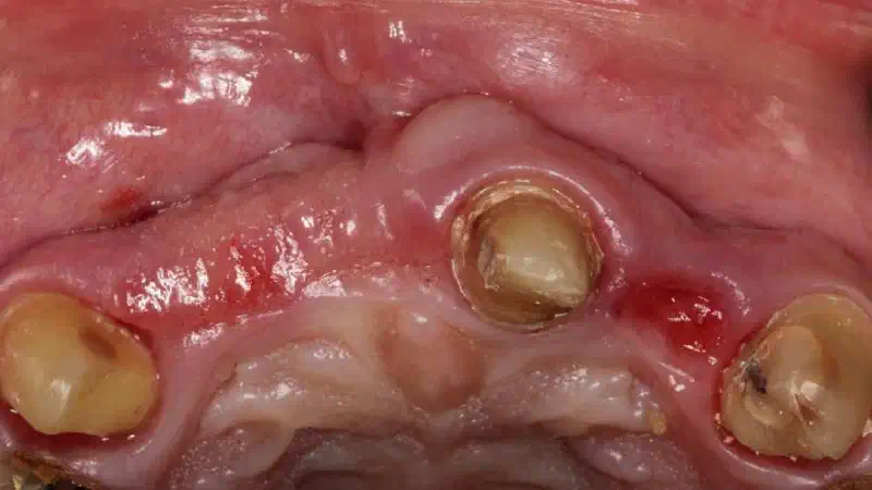 Pre-prosthetic soft tissue augmentation of the ridge contour with mucoderm®