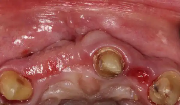 Image for case Pre-prosthetic soft tissue augmentation of the ridge contour with mucoderm®