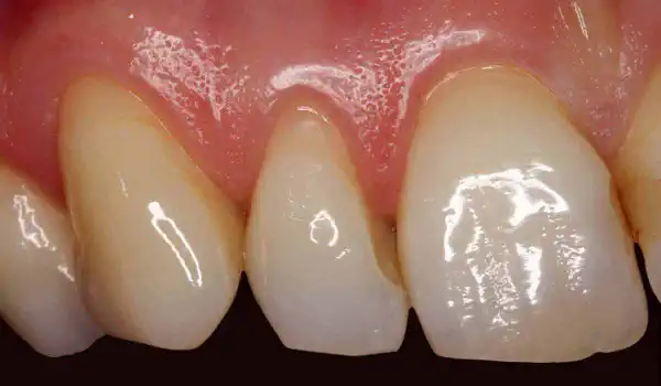 Image for case Multiple gingival recessions treated with mucoderm®