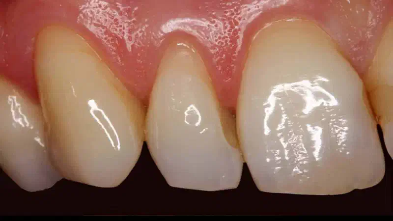Multiple gingival recessions treated with mucoderm®