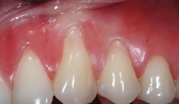 Image for case Multiple gingival recessions treated with the modified coronally advanced tunnel in conjunction with mucoderm®