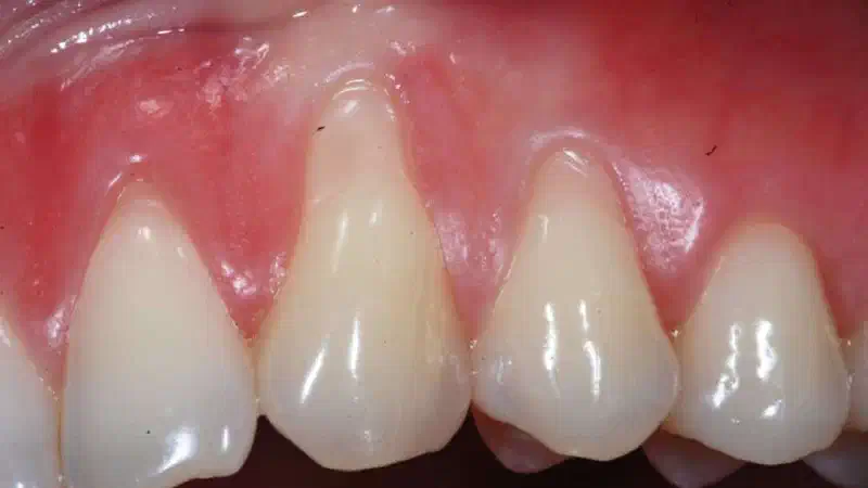 Multiple gingival recessions treated with the modified coronally advanced tunnel in conjunction with mucoderm®